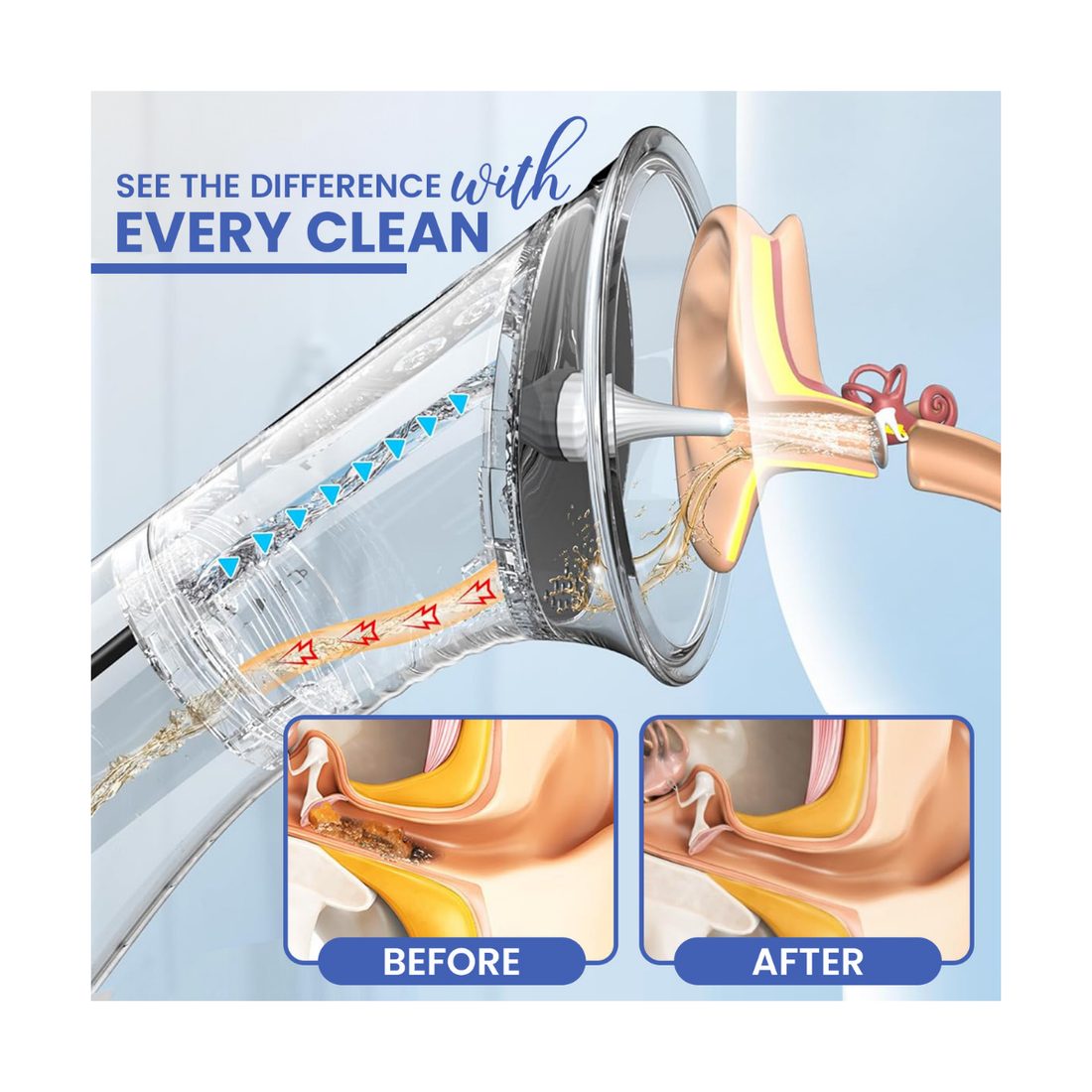 Zeyora Electric Ear Wax Removal Kit
